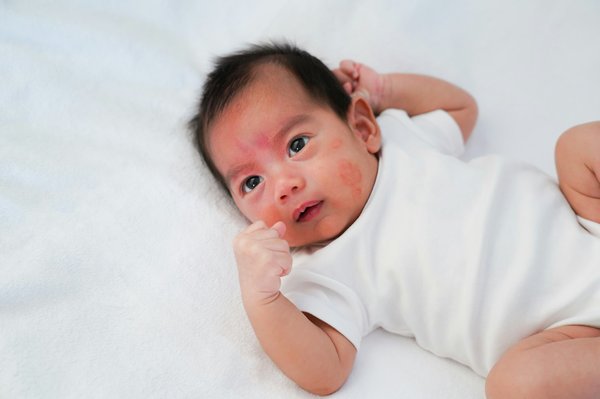 Eczéma bébé : soulager l'irritation avec des soins adaptés